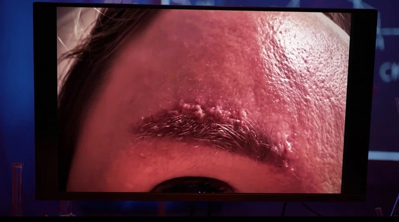 Жительница Железноводска испытала опасную процедуру вживления бровей